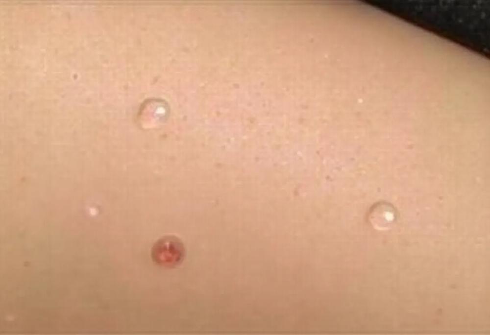 Skin texture