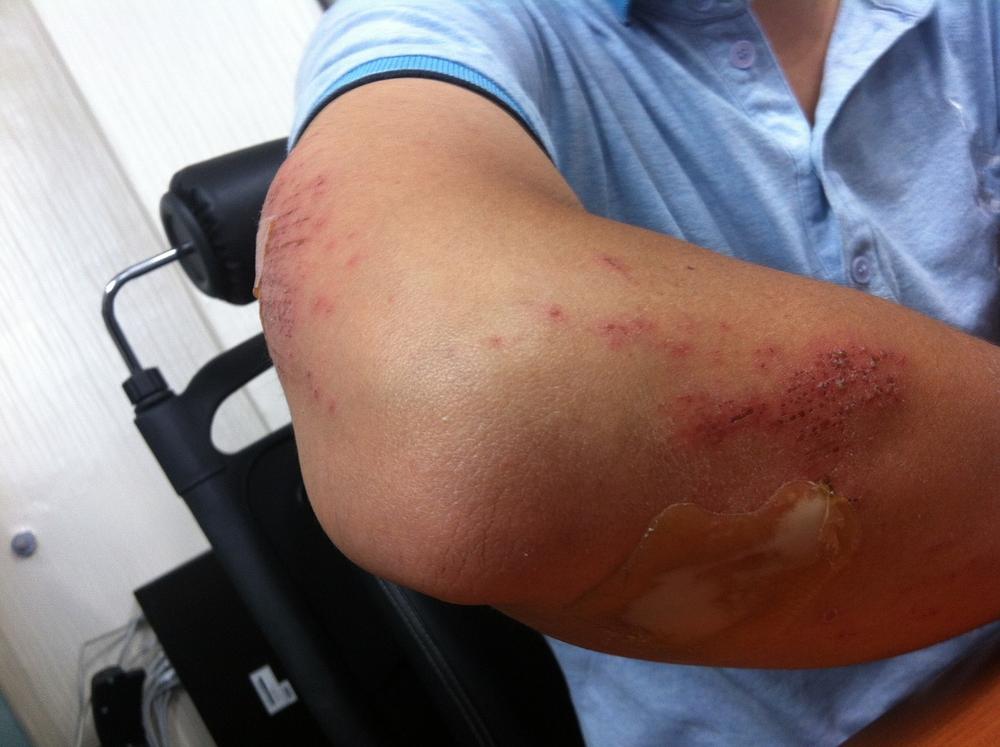 skin bruise