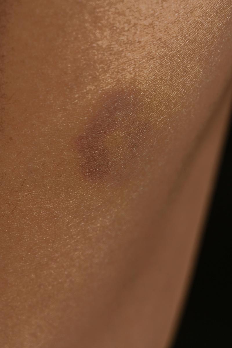 skin bruise